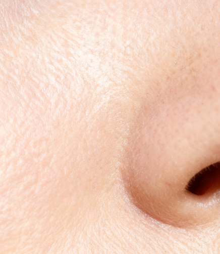 Fitzpatrick Type 1 skin without sunscreen