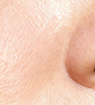 Fitzpatrick Type 1 skin with Bioshield SPF 30 applied