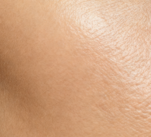 Fitzpatrick Type 2 skin without sunscreen