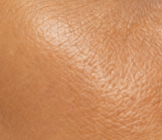 Fitzpatrick Type 3 skin with Bioshield SPF 30 applied