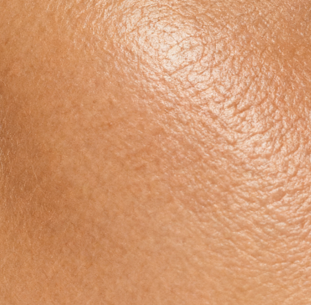 Fitzpatrick Type 3 skin without sunscreen