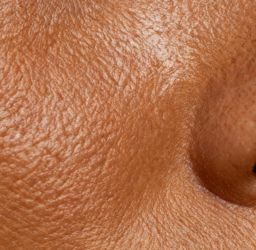 Fitzpatrick Type 4 skin without sunscreen