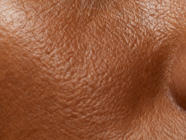 Fitzpatrick Type 4 skin with Bioshield SPF 30 applied