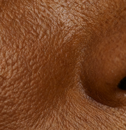 Fitzpatrick Type 5 skin with Bioshield SPF 30 applied