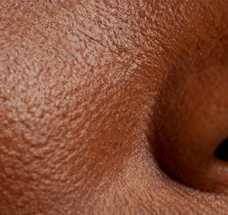 Fitzpatrick Type 6 skin with Bioshield SPF 30 applied